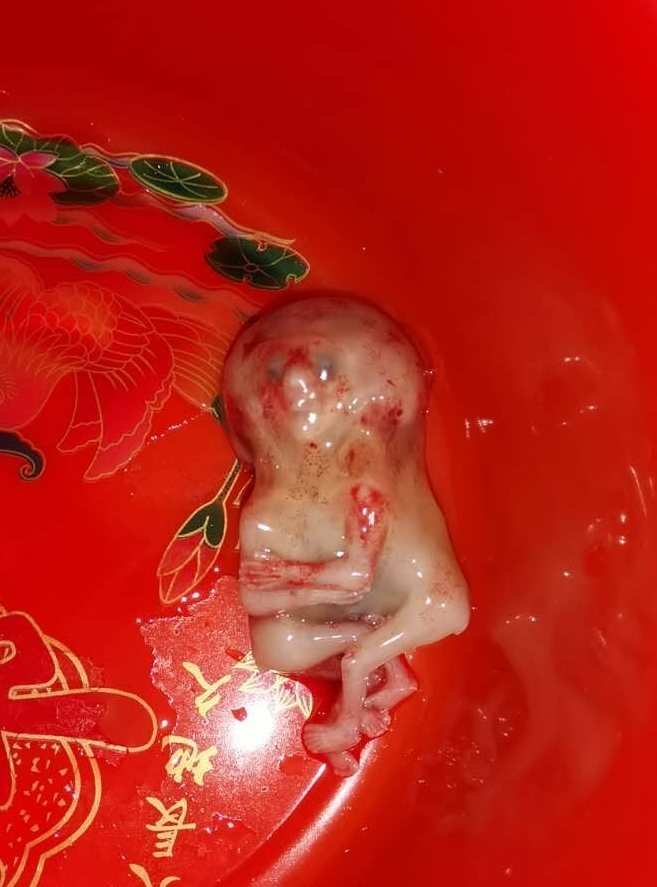孕酮低要不要保胎医院一般会这样：低