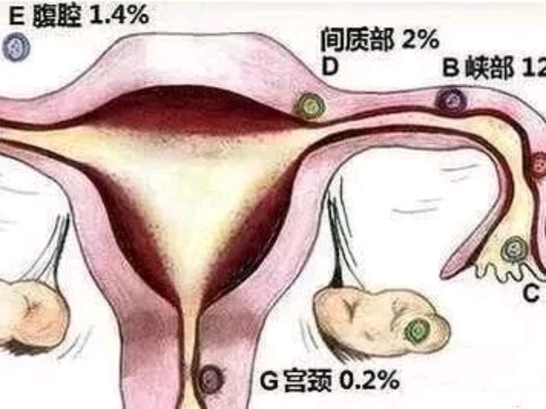 宫外孕康复后怎么备孕_宫外孕后怎么备孕_宫外孕怎样备孕