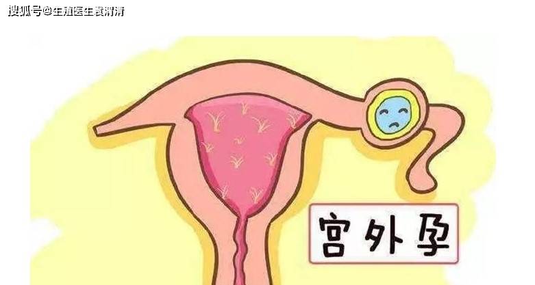 宫外孕后怎么备孕_宫外孕康复后怎么备孕_宫外孕怎样备孕