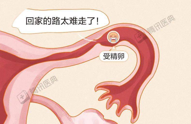 导致宫外孕的五个原因，不当的避孕方式！