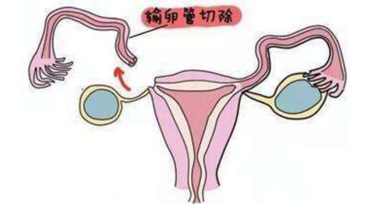 宫外孕后怎么备孕_宫外孕后怎样调理身体备孕_宫外孕康复后怎么备孕