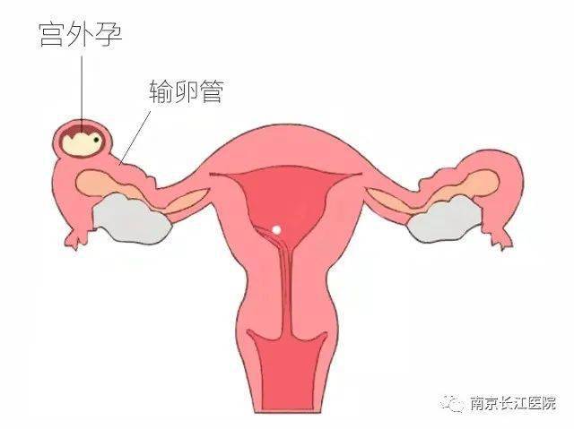 宫外孕康复后怎么备孕_宫外孕后怎么备孕_宫外孕后怎样调理身体备孕