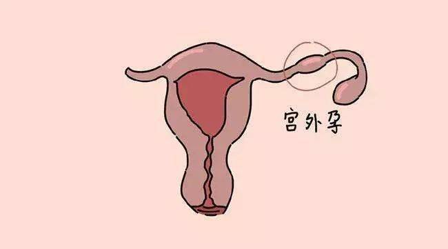 宫外孕后怎样调理身体备孕_宫外孕女性备孕计划_宫外孕后怎么备孕