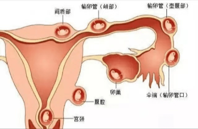 宫外孕后多久可以在备孕_宫外孕备孕_宫外孕后怎么备孕