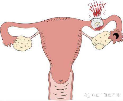 宫外孕备孕_宫外孕后怎么备孕_宫外孕后多久可以在备孕