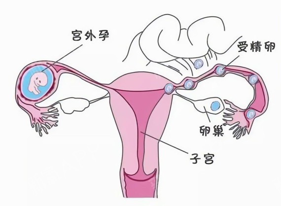 宫外孕后多久可以在备孕_宫外孕备孕_宫外孕后怎么备孕