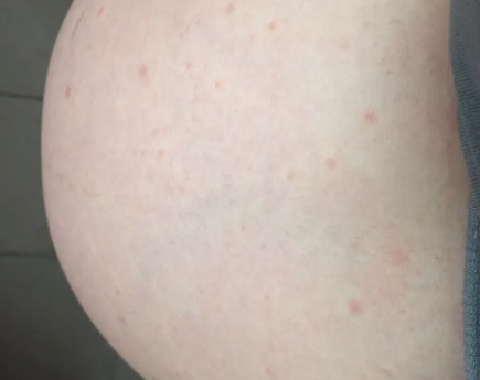 孕妇身上长红点点不痛不痒