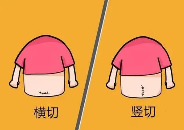 「剖宫产」伤口多久才能完全愈合