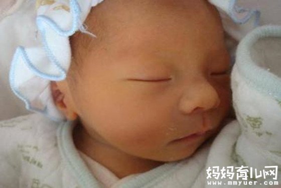 新生儿黄疸怎么消除的中医疗法 湿疹宝宝的“福音”