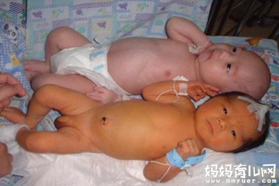 【什么是溶血性黄疸】溶血性黄疸病因 溶血性黄疸好治吗