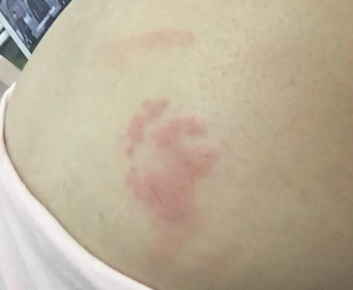 孕妇长疱疹的图片