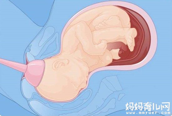 10个准妈9个都在问：顺产侧切是什么意思 看完秒懂！