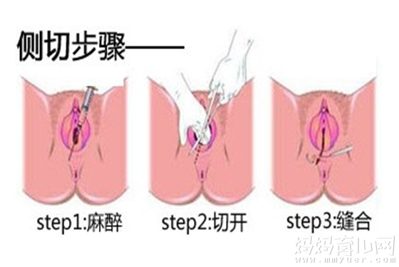 顺产一定要侧切吗?顺产不想侧切怎么办？
