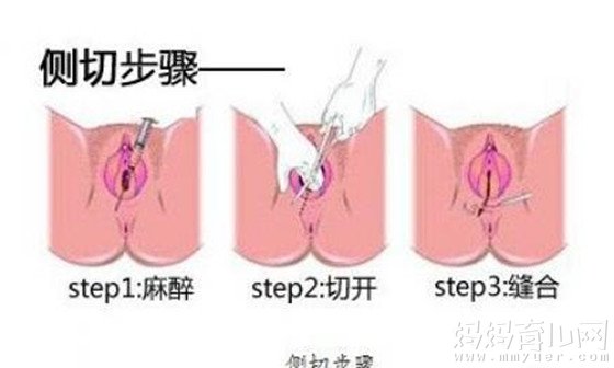 私处护理不当易感染 顺产侧切伤口清洗步骤请收好
