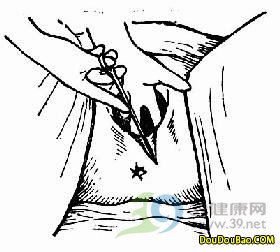 顺产时做了会阴侧切会影响以后的夫妻生活吗?