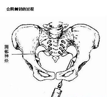 女人顺产生孩子会阴侧切全过程（图片）