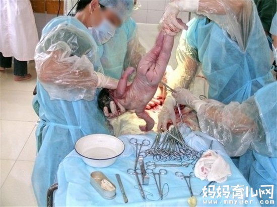宝宝胎位不正一定要剖腹产吗 哪些情况不得不剖宫产