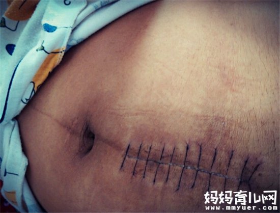 剖腹产疤痕修复如何快速有效 剖腹产疤痕修复注意要点