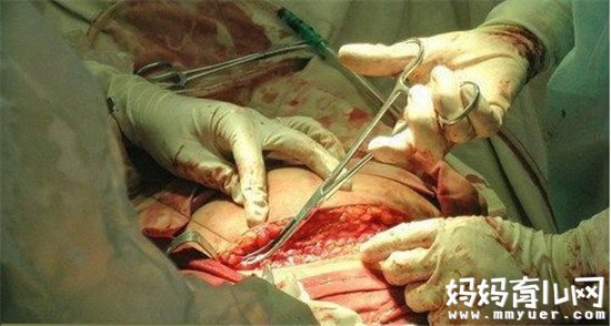 孕妇高度近视只能剖腹产吗 哪些孕妈妈最适合剖腹产