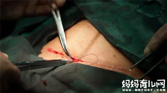 做剖腹产的最佳时间 产妇须知做剖腹产的相关事宜