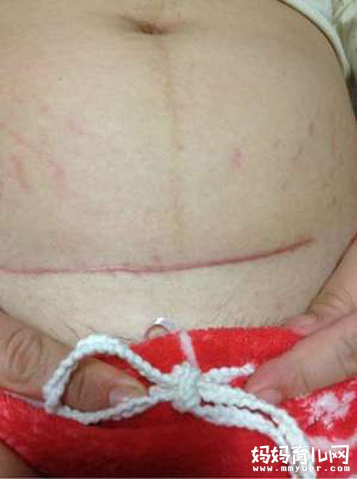 剖腹产横切、竖切各有优缺点，孕妇可自主选择不必太纠结
