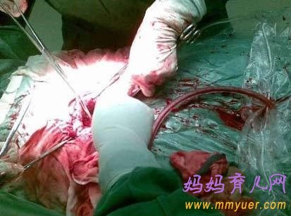 专家解密：剖腹产后遗症有哪些？