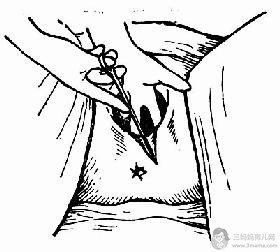 女人顺产侧切伤口图片与缝针 - 顺产