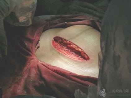 年轻妈妈剖腹产视频全过程 - 剖腹产