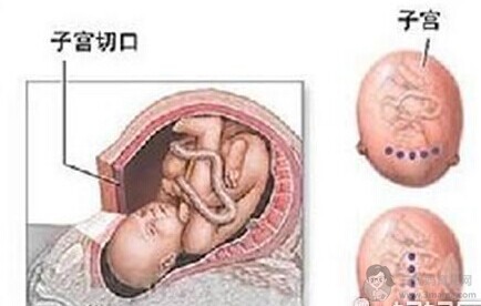 剖腹产后再次怀孕 孕妇不可不知道那些事！ - 剖腹产