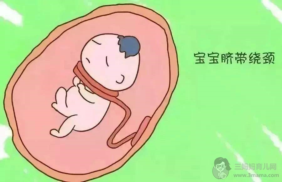 脐带绕颈会影响顺产吗？ - 顺产