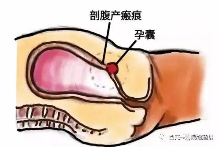 怀孕3周到子宫里了吗