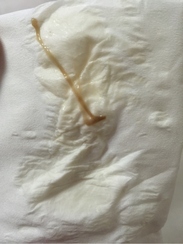 孕4周流褐色分泌物