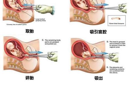 怀孕9周适合做什么人流