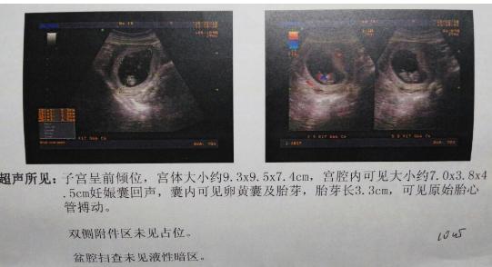 怀孕10周可以查男女吗