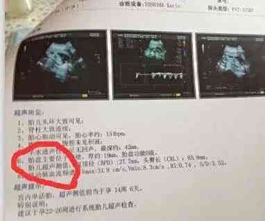怀孕24周羊水深度正常值