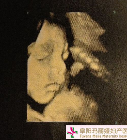 24周三维彩超图片