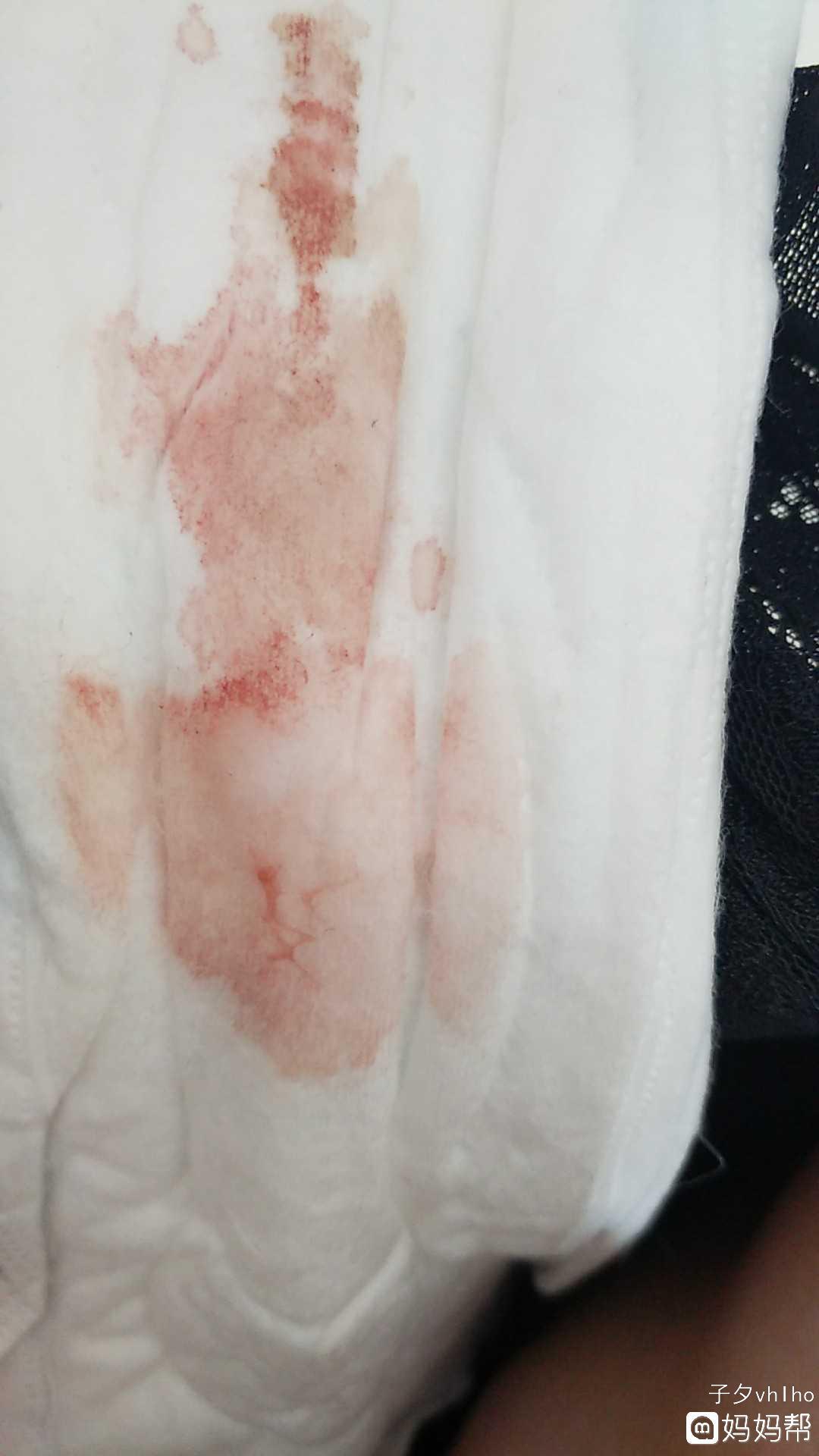 怀孕26周突然出血无痛