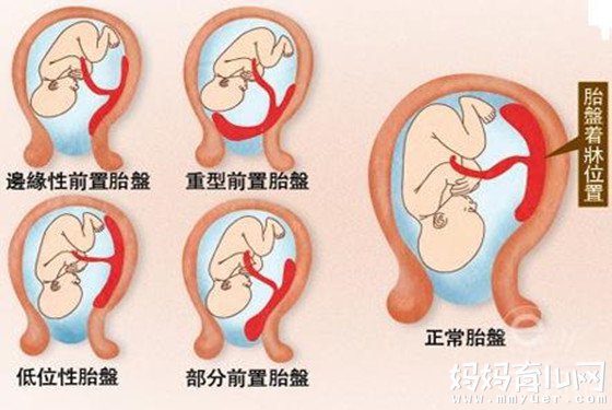 【胎盘前置】胎盘前置的后果 胎盘前置怎么治疗