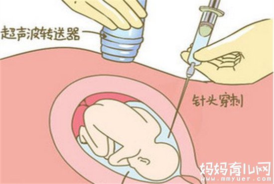 纠结无创DNA和羊水穿刺哪个好 不妨看看优缺点分析