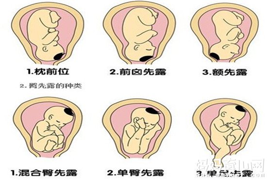 胎儿臀位怎么纠正有方法 不妨学学这三种姿势！
