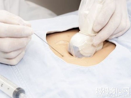 羊水亲子鉴定怎么做 只要三步轻松搞定