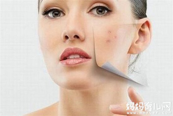 脸上长痘痘怎么调理的秘诀 6个小方法让烦人痘痘消失不见