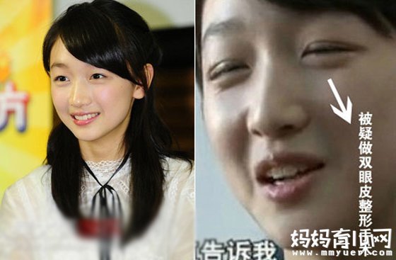 周冬雨割双眼皮前后对比照 单双的区别还真不小