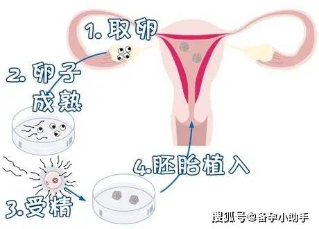 供卵试管婴儿的成功率是人为控制挑选优质卵子？