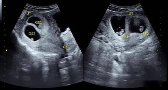 受限生长的宝宝健康吗_高血压孕妇生的宝宝健康吗_孕妇肝功能异常。宝宝健康