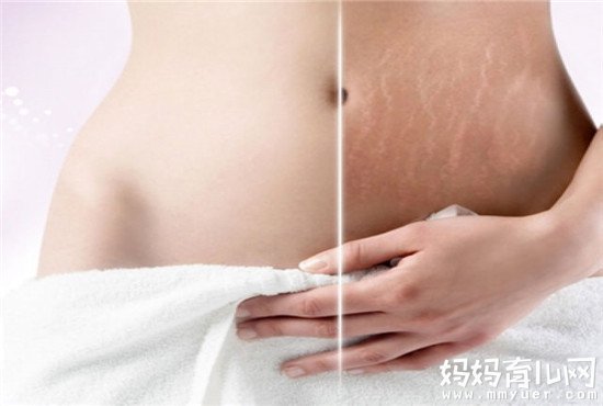 别再纠结妊辰纹霜什么牌子好 这三款试过的宝妈都说不错