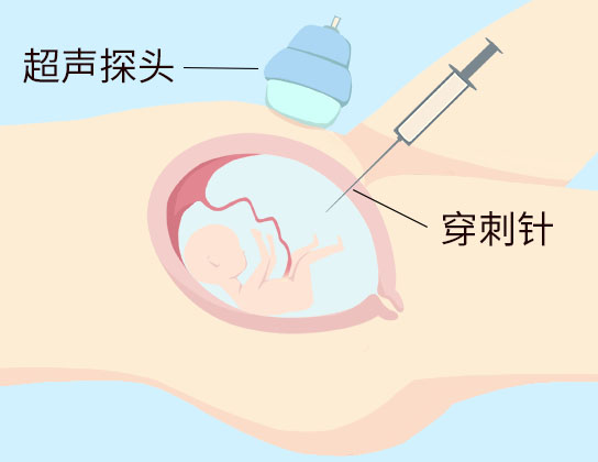 确诊染色体畸形的金标准——羊水穿刺，到底要不要做？