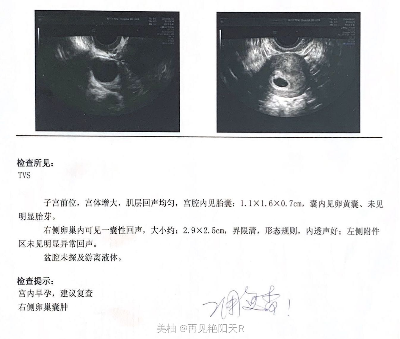 接男宝咯，酸儿辣女不准，史上最全最详细的备孕怀孕到生产的过程