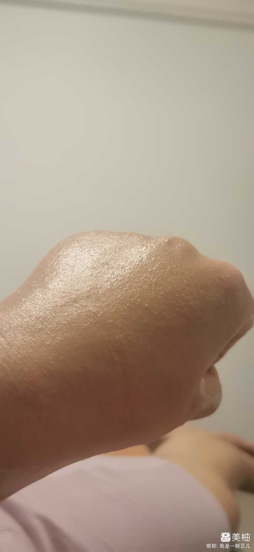 孕期过敏性皮炎的看过来