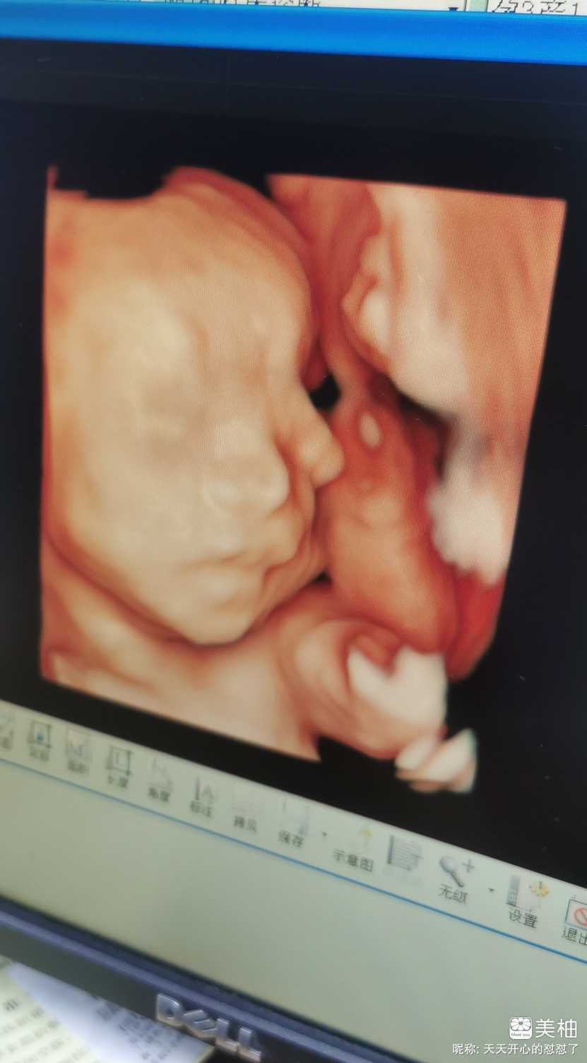 29周+5天，脐带绕颈一周，“喜提”胎心监护仪一台